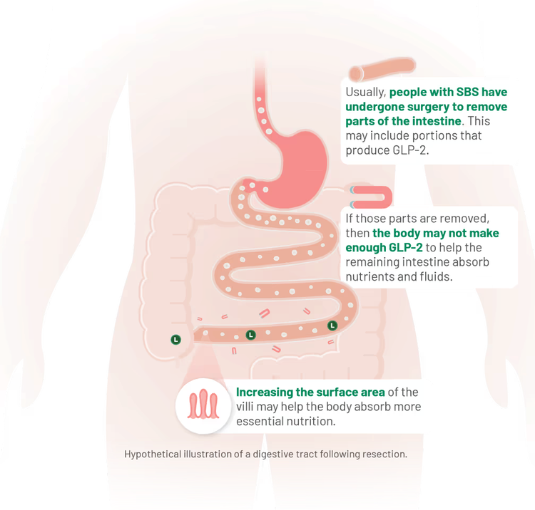 Illustration of a resected intestine showing reduced GLP-2 production and nutrient absorption challenges